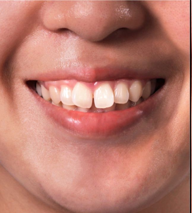 Antes: Ortodontia Completa