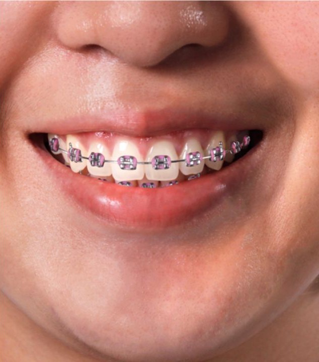 Depois: Ortodontia Completa