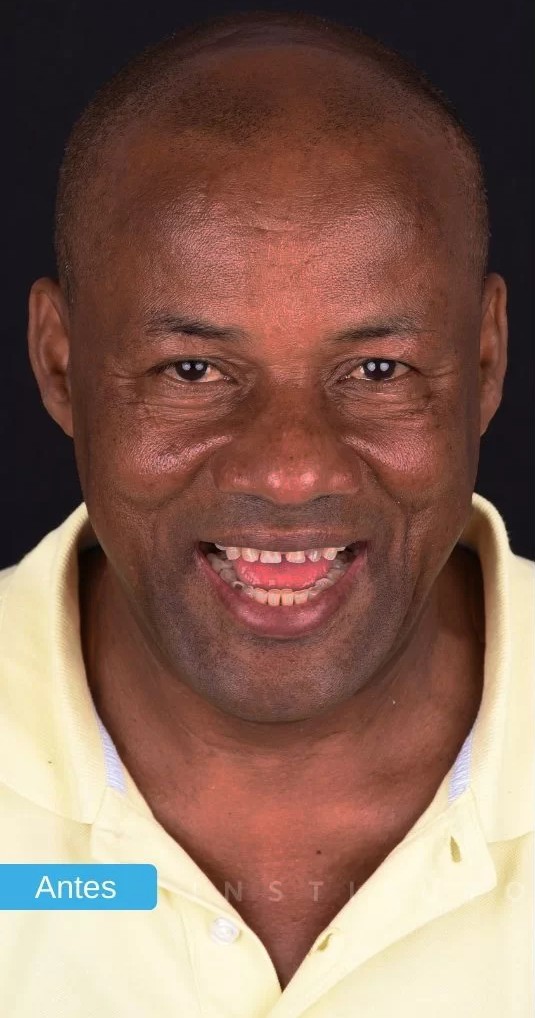 Antes: Reabilitação Oral