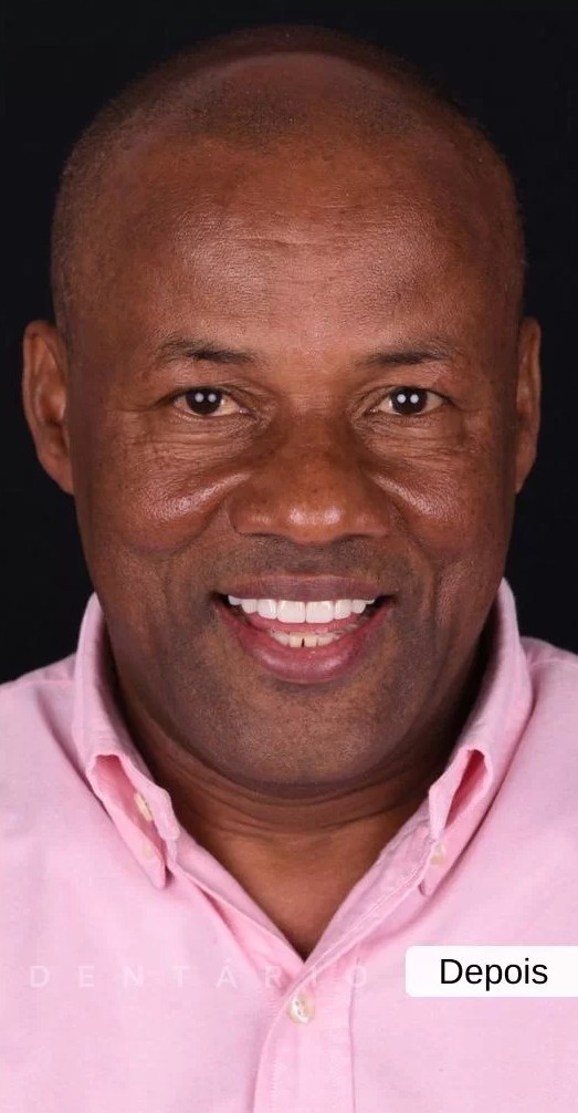 Depois: Reabilitação Oral